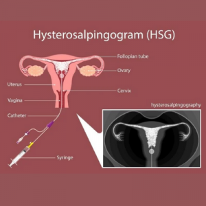 How Is This HSG Test Done? steps of HSG test